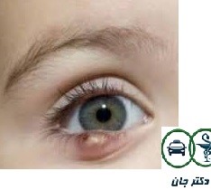 عوارض بیماری التهاب چشم یا بلفاریت