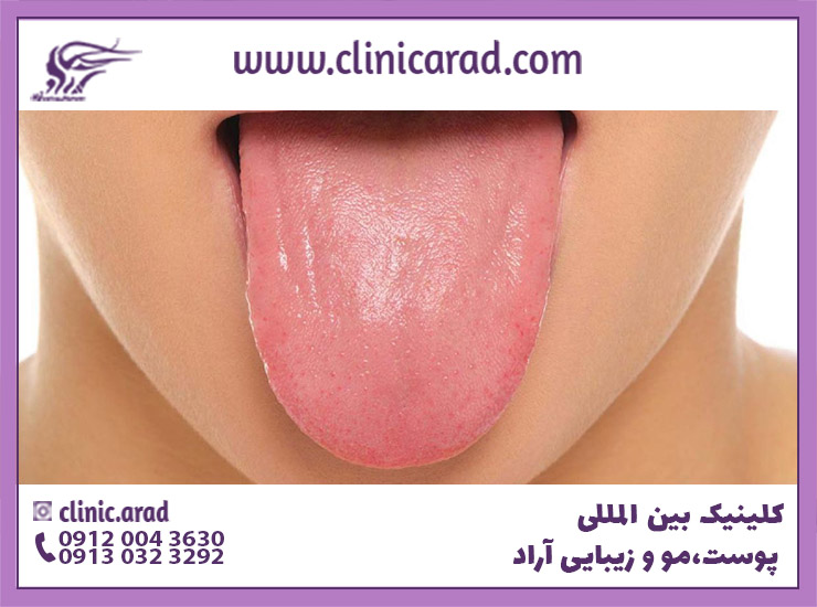 التهاب زبان (گلوسیت‌)