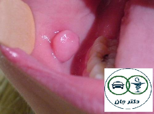 تومورهای خوش‌خیم دهان و زبان‌